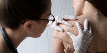 Chickenpox-Treatment